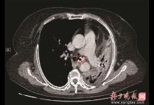 阿姨咳嗽十幾年，把左肺咳“沒(méi)”了？ “元兇”竟是顆假牙