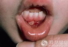 老太太因口腔潰瘍被割舌頭？兩周不愈當心是癌！