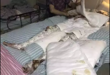 做飯時(shí)廚房突爆炸 23歲美女碩士全身70%燒傷