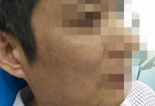 廣州大叔鐵片藏臉30年未發現，取出后自己嚇一跳