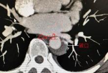 女子練瑜伽致心臟主動脈破裂 醫(yī)生稱第一次見