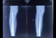 廊坊“城南醫(yī)院院長(zhǎng)墜樓”后續(xù)：楊玉忠曾被舉報(bào)侵占集體資產(chǎn)