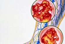 新研究表明：靜脈曲張與血栓發作幾率增高有關