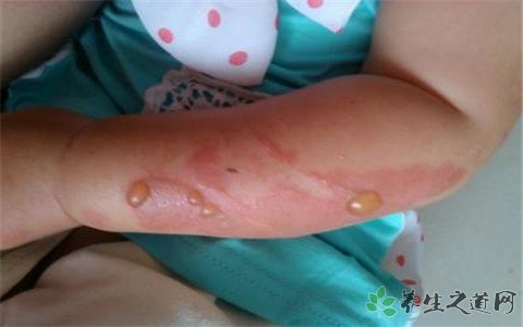 女孩玩火一家燒傷 被大火燒傷怎么辦 女孩玩火一家燒傷 被大火燒傷怎么辦