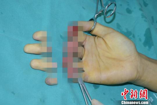 男子突發(fā)意外七根手指被壓斷 醫(yī)生順利接上