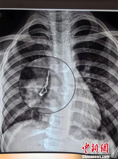 男孩誤吞LED發光二極管 深入支氣管險些扎破肺