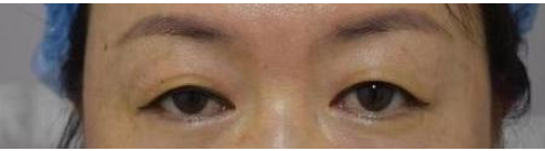 南昌禾麗整形失敗 女子花18000整形后跟術前照對比尷尬了