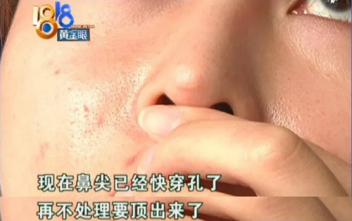 杭州麗星整形醫院整壞了鼻子至妍醫療美容來修復 醫院更名了？