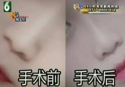 杭州世彩整形又遭消費者投訴 采訪時院方代表有些激動