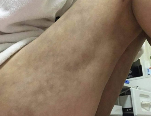 南昌亞太醫療美容醫院抽脂手術后情況很糟糕 女子維權卻被罵出來