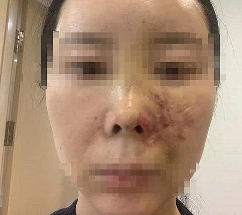 女子在沈陽美萊整形后面部青紫不敢見人 賠償問題未能達成一致