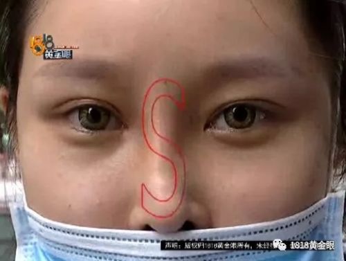 三女子整容均出現(xiàn)不同程度歪斜 義烏陽光美容醫(yī)院：本身就有問題