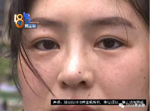 寧波童顏美容整形醫(yī)院整形失敗了？女子：被毀容了