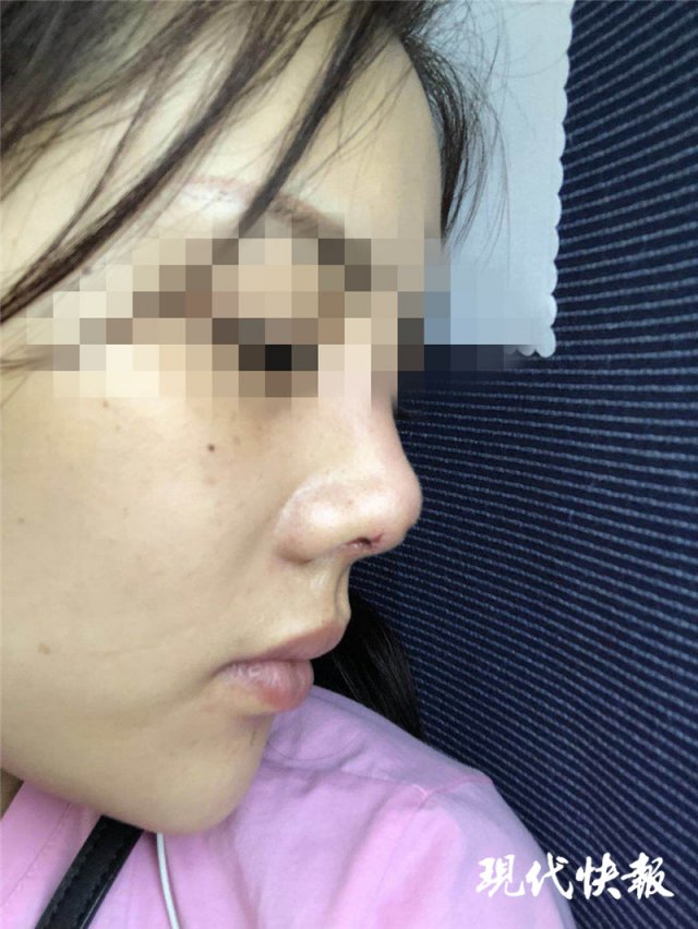 南京怡華醫療美容醫院整形失敗 90后姑娘隆鼻后成了“豬鼻子”