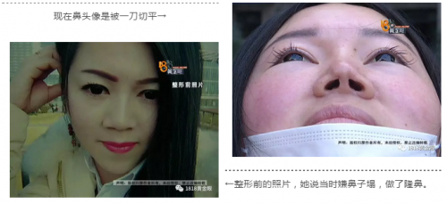 動(dòng)了三次刀 患者：湖州曙光醫(yī)療美容醫(yī)院把我鼻子做的跟豬一樣