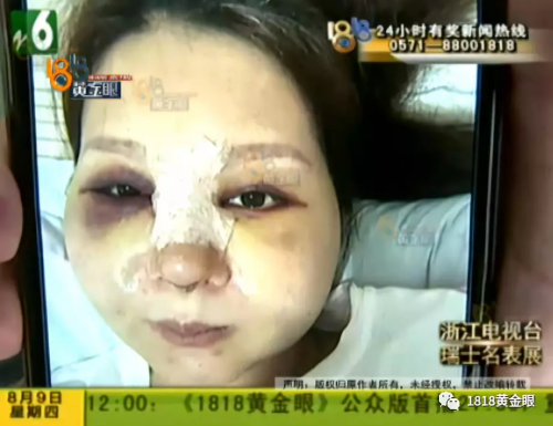 想要“柔美”結果寧波益寶醫療美容把她整像豬頭？