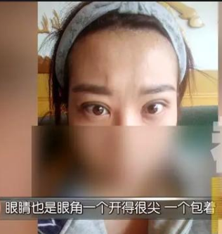 貸款6萬(wàn)多在西安華醫(yī)天美整形醫(yī)院整容后變丑了 女子流下后悔的眼淚