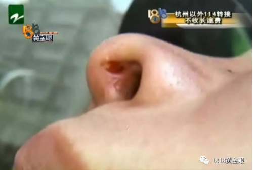 女子在寧波尚美整形醫院整形失敗 手術效果差傷口還化膿