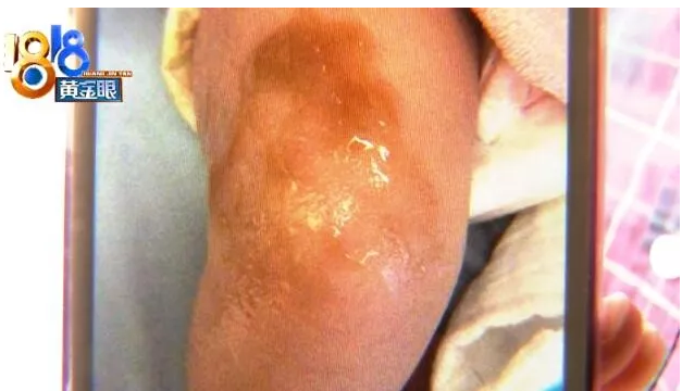 杭州馨紫羅蘭月子會所坐月子 媽媽跟寶寶都燙傷了？