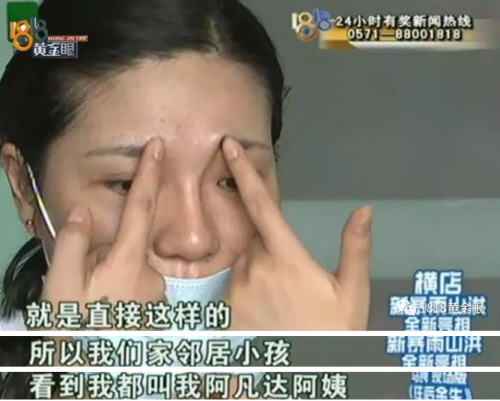 女子在紹興華美整形醫院整形后眼睛有異物感 鼻子也被整成像阿凡達
