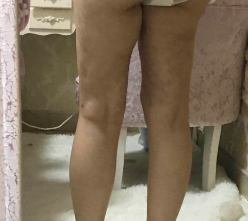 南昌亞太醫療美容醫院抽脂手術后情況很糟糕 女子維權卻被罵出來