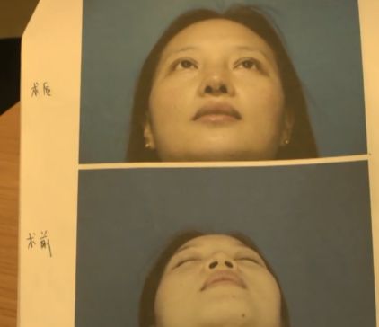 杭州美萊美容醫院把我鼻子做壞了 高價隆鼻后凹凸不平