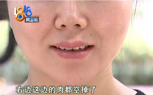 杭州維多利亞醫療美容醫院溶脂術后不如從前好看 整個人顯得很憔悴