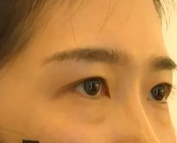 女子在杭州珈禾整形美容醫(yī)院打熊貓針結果變成熊貓眼？