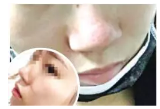 泉州逸膚中醫皮膚病醫院激光祛痘坑失敗 院方:已辦理退款-易網健康<a href=http://www.gyfww.com/jkys/ target=_blank class=infotextkey>養生</a>網 泉州逸膚中醫皮膚病醫院激光祛痘坑失敗 院方:已辦理退款