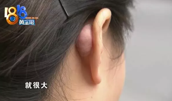 杭州千晴整形醫(yī)院隆鼻后耳后根長了個包 鼻孔也一大一小