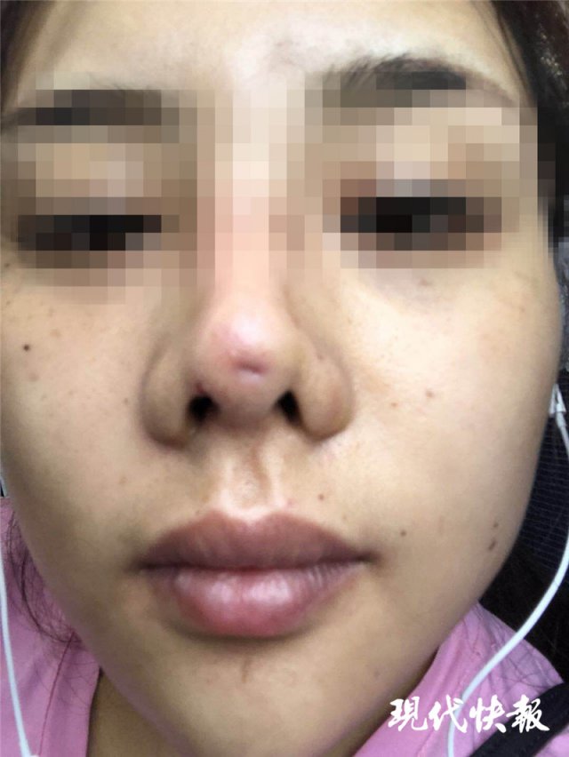 南京怡華醫療美容醫院整形失敗 90后姑娘隆鼻后成了“豬鼻子”