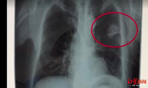 玉佩致胸片陰影誤診？四川勞研科技有限公司體檢顯示正常 男子一年后去世