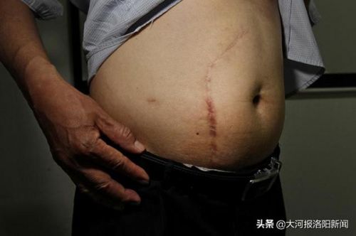 13年前只在洛陽市商業職工醫院做過一次闌尾手術 為何膽囊不見了？