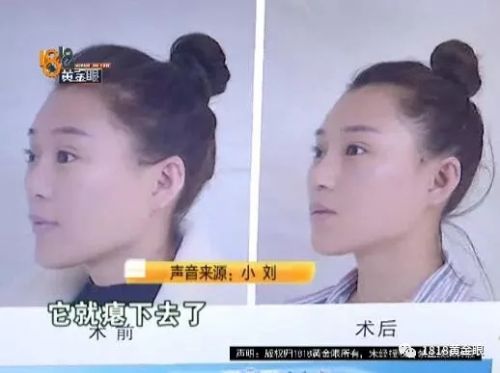 三女子整容均出現(xiàn)不同程度歪斜 義烏陽光美容醫(yī)院：本身就有問題