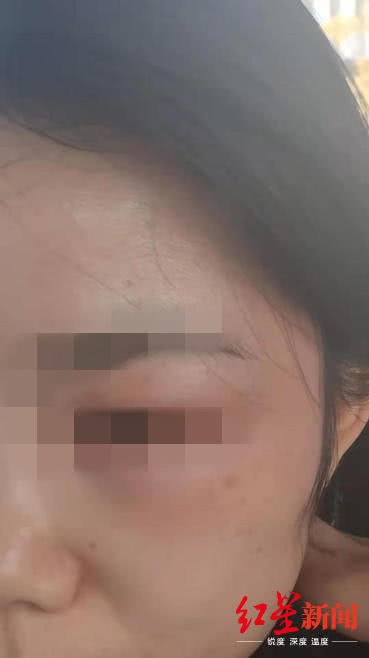 女子在宜賓韓美整形后差點毀容 醫院：個體差異