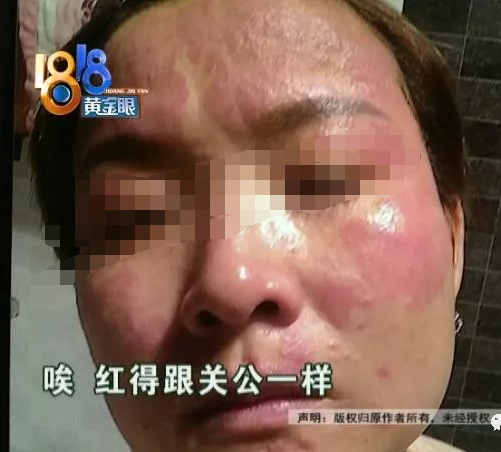 本想“逆時光” 結果密思芬美容后臉紅得像關公不敢見人