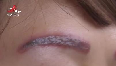 去南昌韓美美容醫院激光洗眉后生不如死 洗完感覺自己像怪物-易網健康<a href=http://www.gyfww.com/jkys/ target=_blank class=infotextkey>養生</a>網 去南昌韓美美容醫院激光洗眉后生不如死 洗完感覺自己像怪物