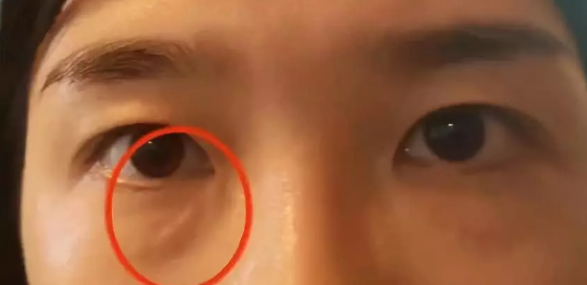 女子在杭州珈禾整形美容醫(yī)院打熊貓針結果變成熊貓眼？