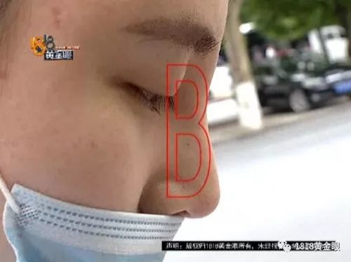 三女子整容均出現(xiàn)不同程度歪斜 義烏陽光美容醫(yī)院：本身就有問題