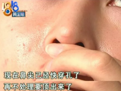 杭州麗星整形醫院整壞了鼻子至妍醫療美容來修復 醫院更名了？