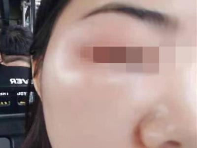 女子在宜賓韓美整形后差點毀容 醫院：個體差異