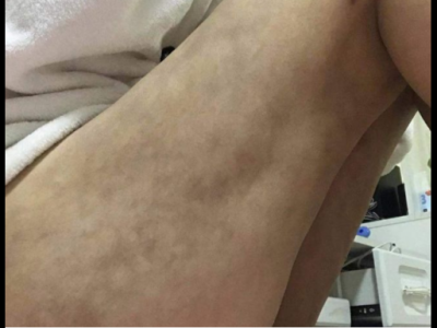 南昌亞太醫療美容醫院抽脂手術后情況很糟糕 女子維權卻被罵出來