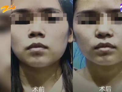 杭州甄美整形醫院把人鼻子整歪了？醫院：自己長歪了