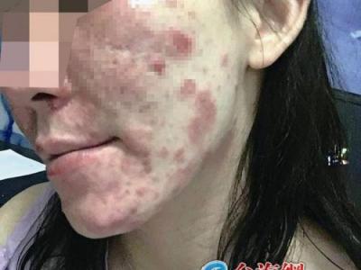 漳州翌芙萊美容店涉嫌無證經營 打“水光針”致女子臉部潰爛變形