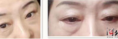 河北一女子在石家莊萬瑞醫療整形后眼睛閉不緊 醫院：不滿意可二次修復