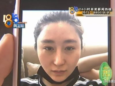 杭州華山連天美整形醫(yī)院把我鼻子做歪了 整的像阿凡達(dá)