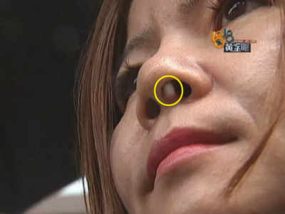 六年前在寧波珈禾整形?？漆t院做隆鼻 現在鼻子不舒服露出白色假體