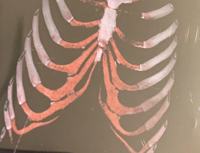 南京普羅普姿醫療美容門診做假手術？神操作！劃個口子就當取了肋骨