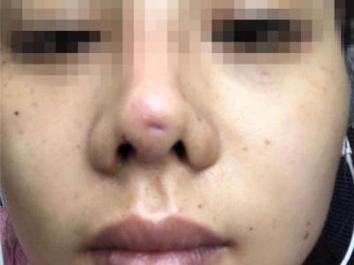 南京怡華醫(yī)療美容醫(yī)院整形失敗 90后姑娘隆鼻后成了“豬鼻子”