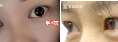 貴陽聚星妍美整形機構又出問題了 雙眼皮整成了單眼皮？